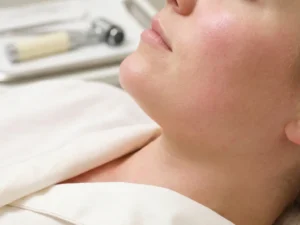 Vrouwenwang met lichte roodheid op wit klinisch linnen na huidbehandeling, medisch apparaat onscherp op achtergrond.