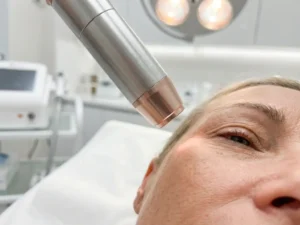 Medische laserhandstuk behandelt rijpe huid rond ooggebied met fijne lijntjes, zacht roosgoud licht, klinische omgeving.