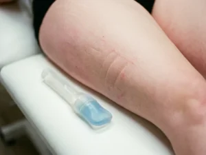 Bovenbeen met lichte roodheid en vingerdruksporen tijdens koelgelbehandeling op witte behandeltafel.