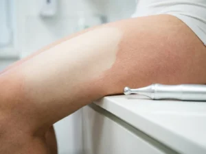 Vrouwelijke dij met zichtbare huidtextuur naast een zilveren radiofrequentie-apparaat op wit klinisch oppervlak.