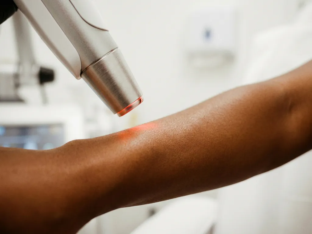 Laserhandstuk boven donkerbruine onderarm tijdens huidbehandeling in witte klinische omgeving.