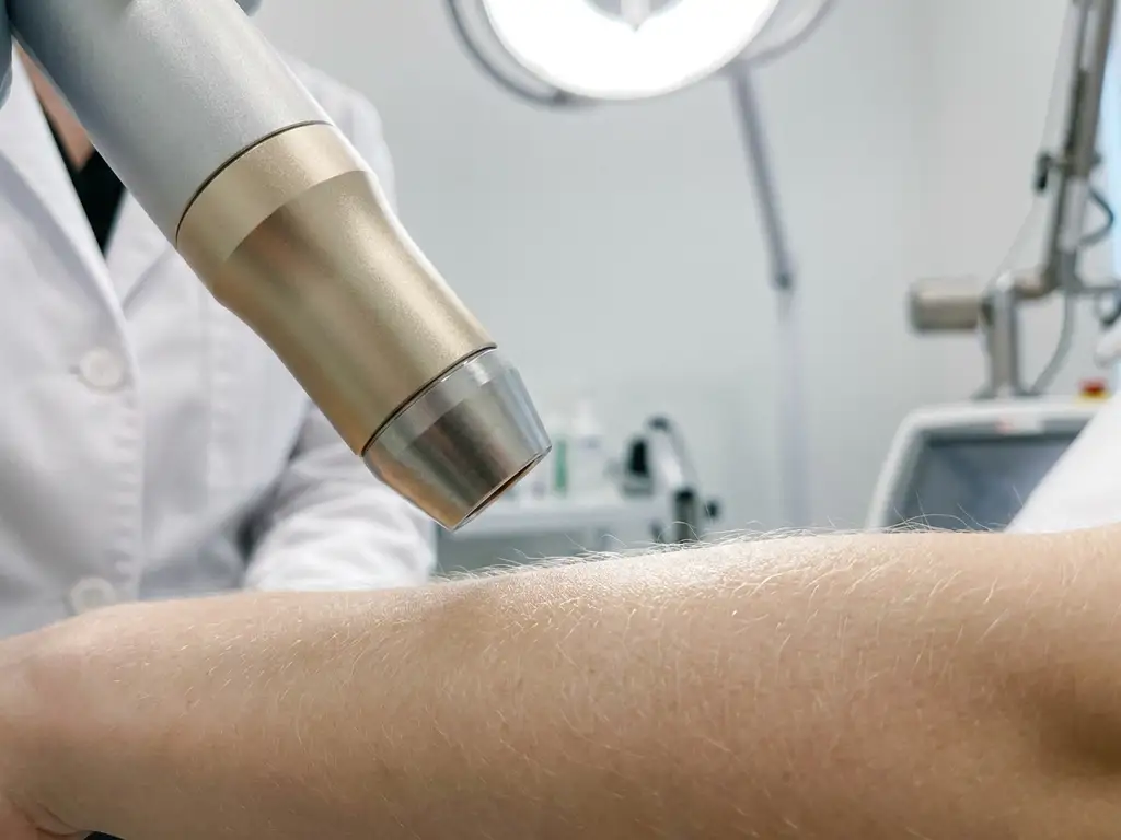 Laserhandstuk boven een onderarm met fijn licht haar tijdens een ontharing behandeling in een klinische omgeving.