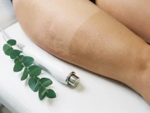 Vrouwelijk dijbeen met gladde en kuilige huidtextuur naast een medisch radiofrequentie-apparaat op wit oppervlak met groen botanisch takje.